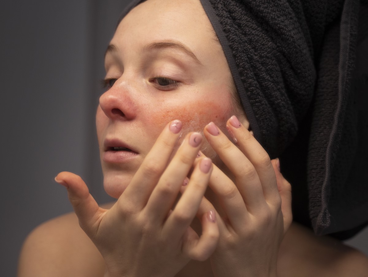 Что такое чувствительная кожа лица?